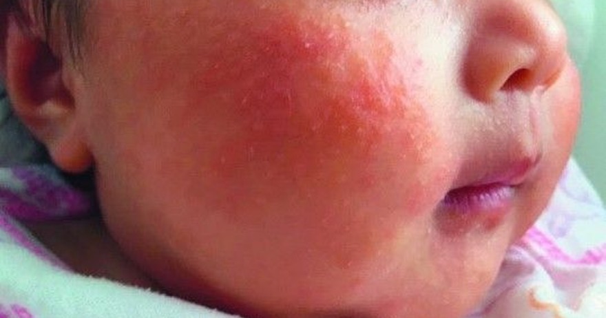 育児 赤ちゃんの顔が爪で傷だらけ 引っ掻き傷の対策まとめ アオマルブログ