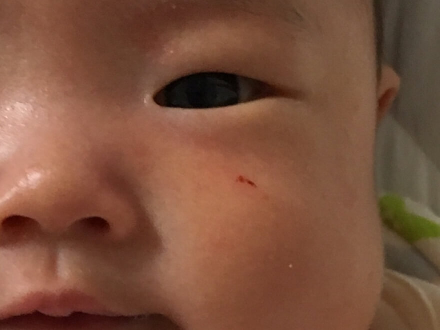【育児】赤ちゃんの顔が爪で傷だらけ…引っ掻き傷の対策まとめ アオマルブログ